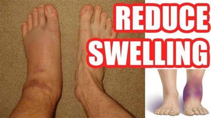 How do you get swelling to go down?