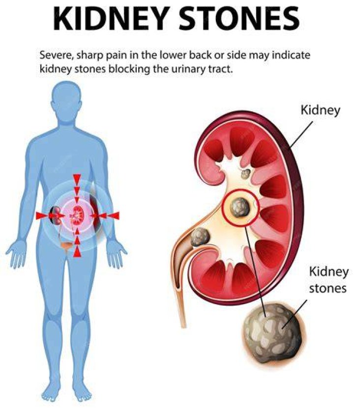 How long does pain from kidney stones last?