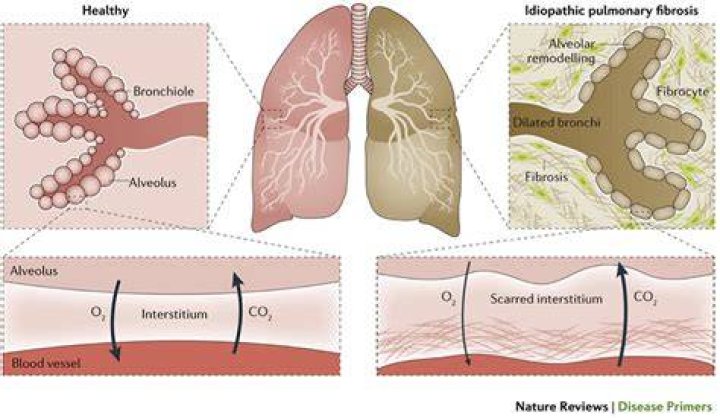 Is pneumoconiosis an interstitial lung disease?
